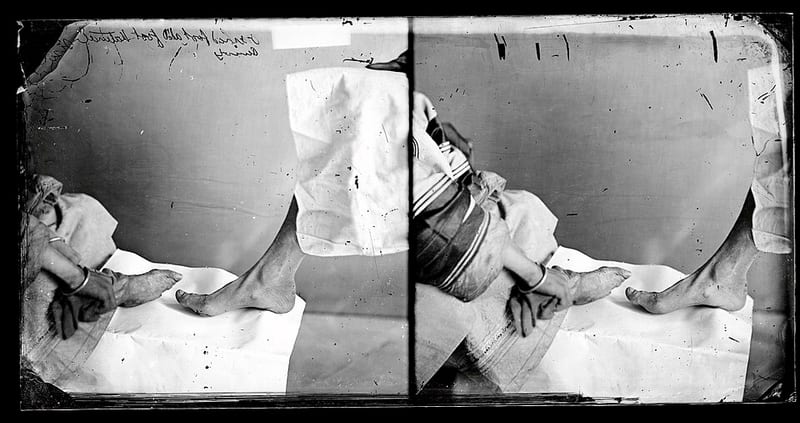 Bound and unbound feet of two Amoy women, photographed by John Thomson, 1869